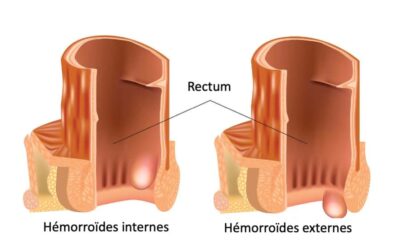 Hémorroïdes : quand consulter et comment les traiter ?