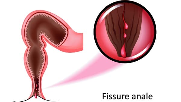 fissure anale traitement que faire specialiste proctologie docteur adnan mougharbel chirurgien visceral digestif paris ile de france